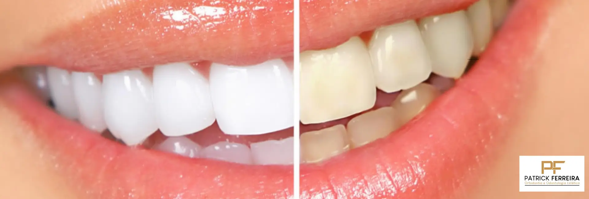 Clareamento Dental