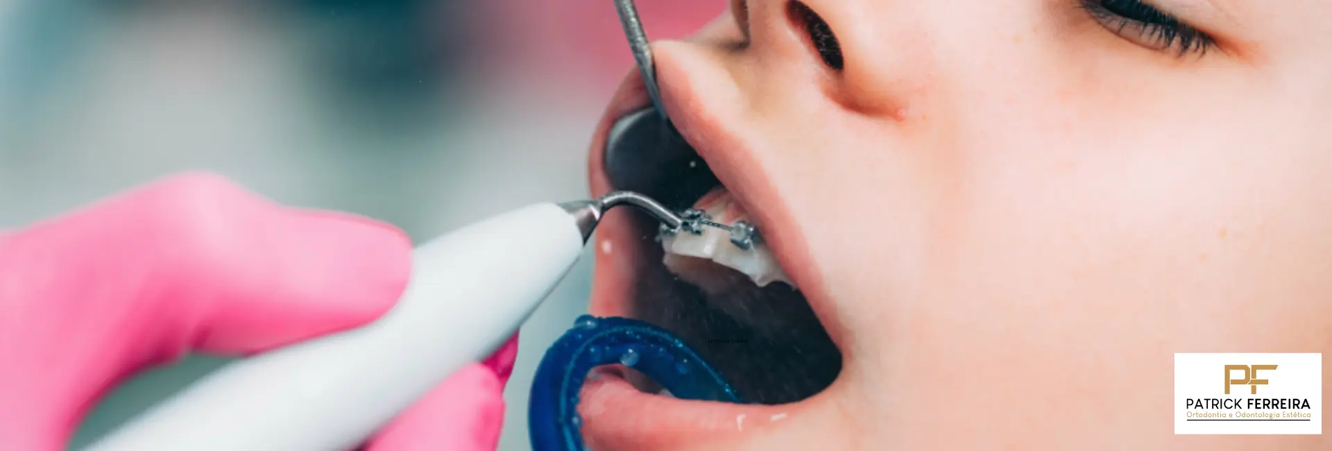 Limpeza Dental com Ultrassom