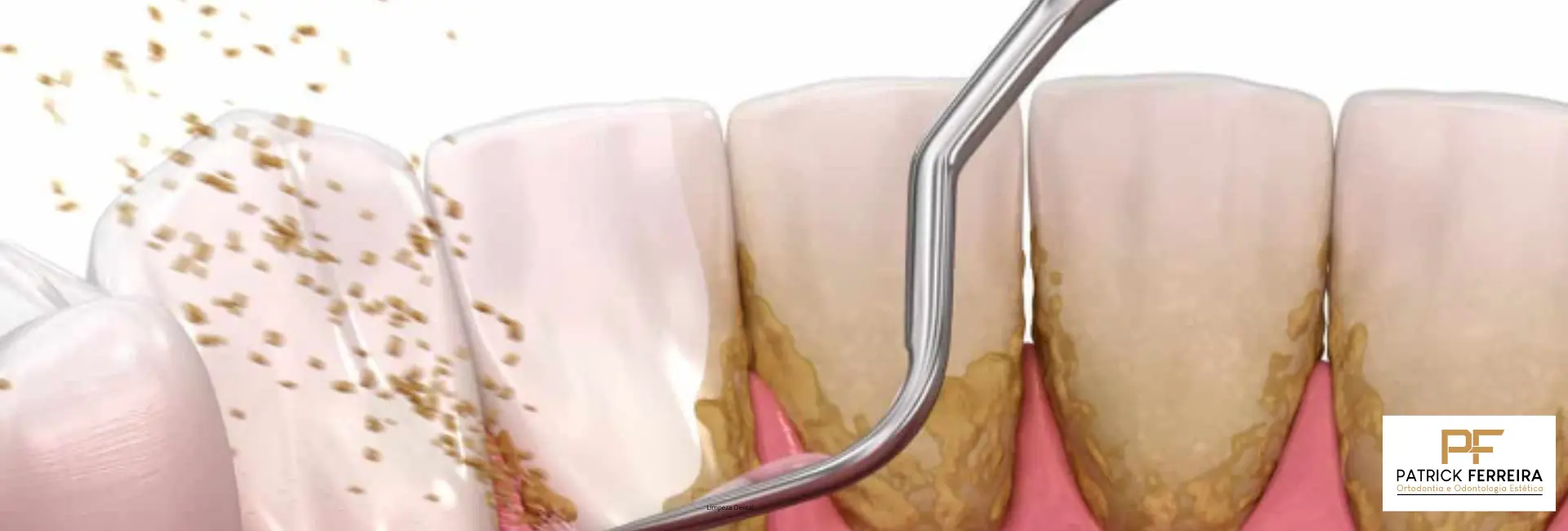 Limpeza Dental Profunda (Raspagem e Alisamento Radicular)