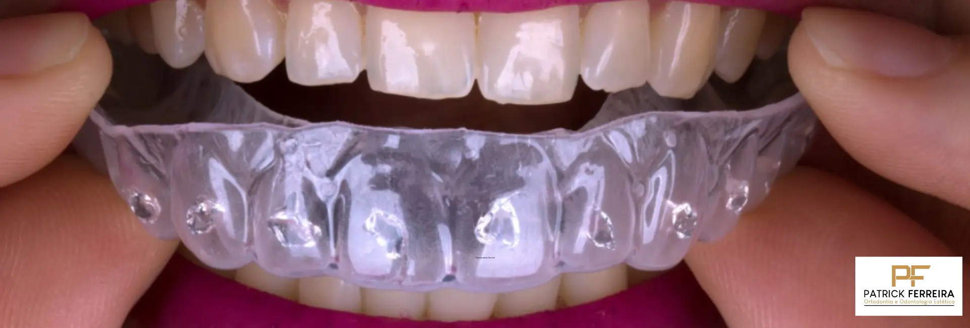 Clareamento Dental com Gel de Peróxido